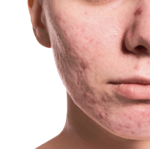 asla acne scar hero image 1 Arka Plani Silindi