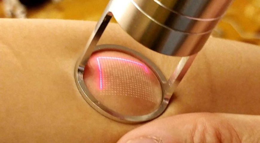 image19852022 03 09 16 39 01co2 fractional laser main Fractional CO2 Laser in Izmir by Dermatologist Dr. Sedef Demirer