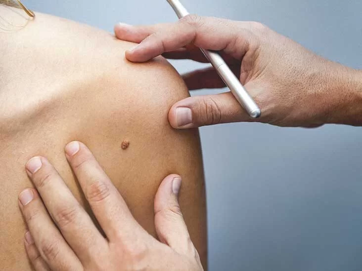 Benlerde ABCDE kuralı ve melanomun erken belirtilerini anlatan dermatoskopik değerlendirme – İzmir Dr. Sedef Demirer