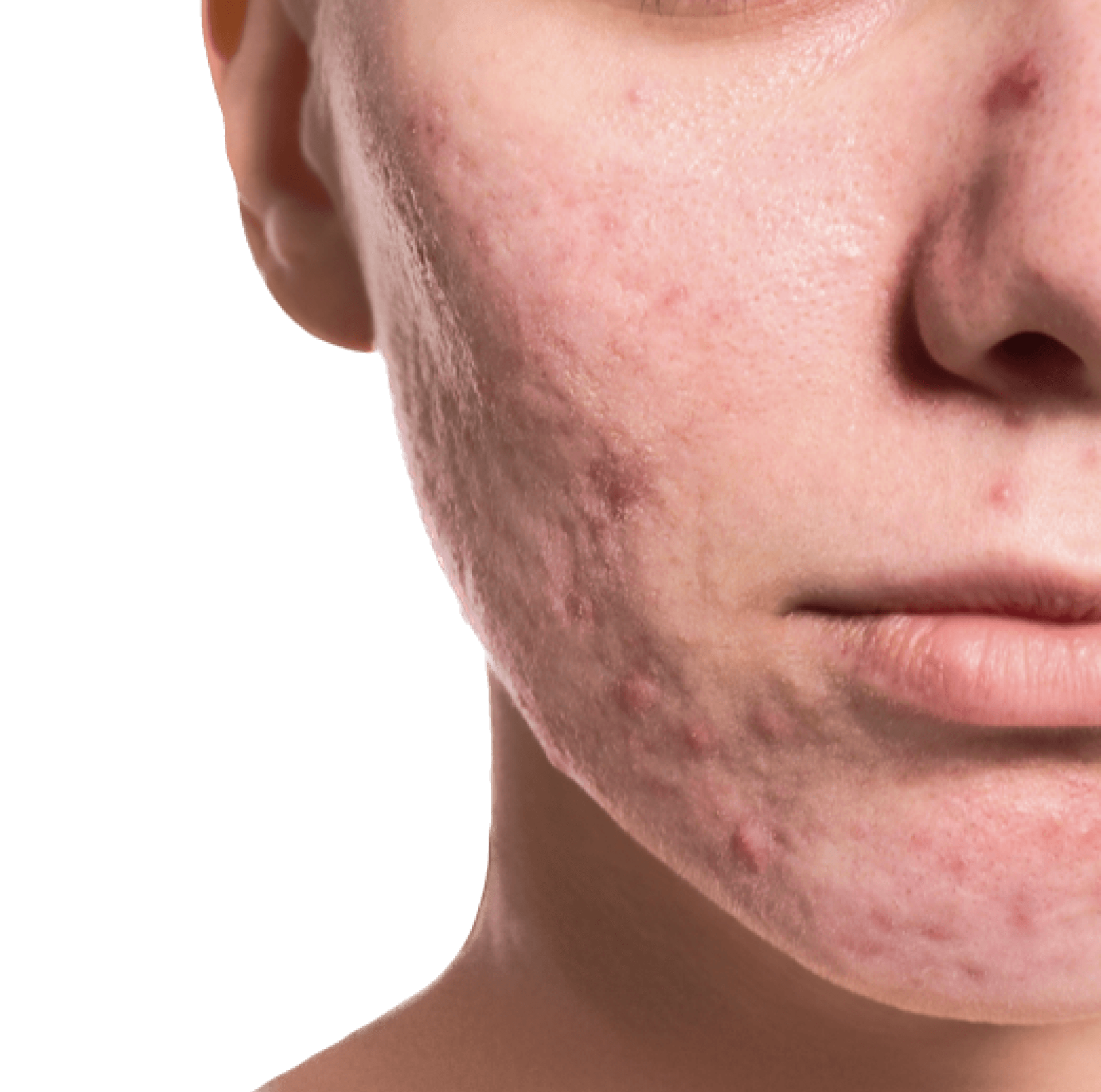 İzmir Alsancak’ta Dermatolog Dr. Sedef Demirer tarafından uygulanan akne izi tedavisi ile cilt görünümünün iyileştirilmesi