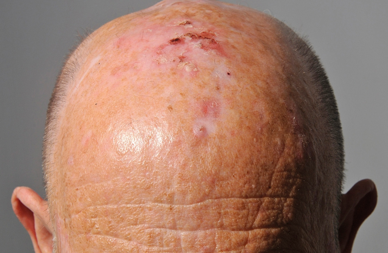 İzmir Alsancak’ta Dermatolog Dr. Sedef Demirer tarafından yapılan deri kanseri tanısı ve dermatolojik değerlendirme