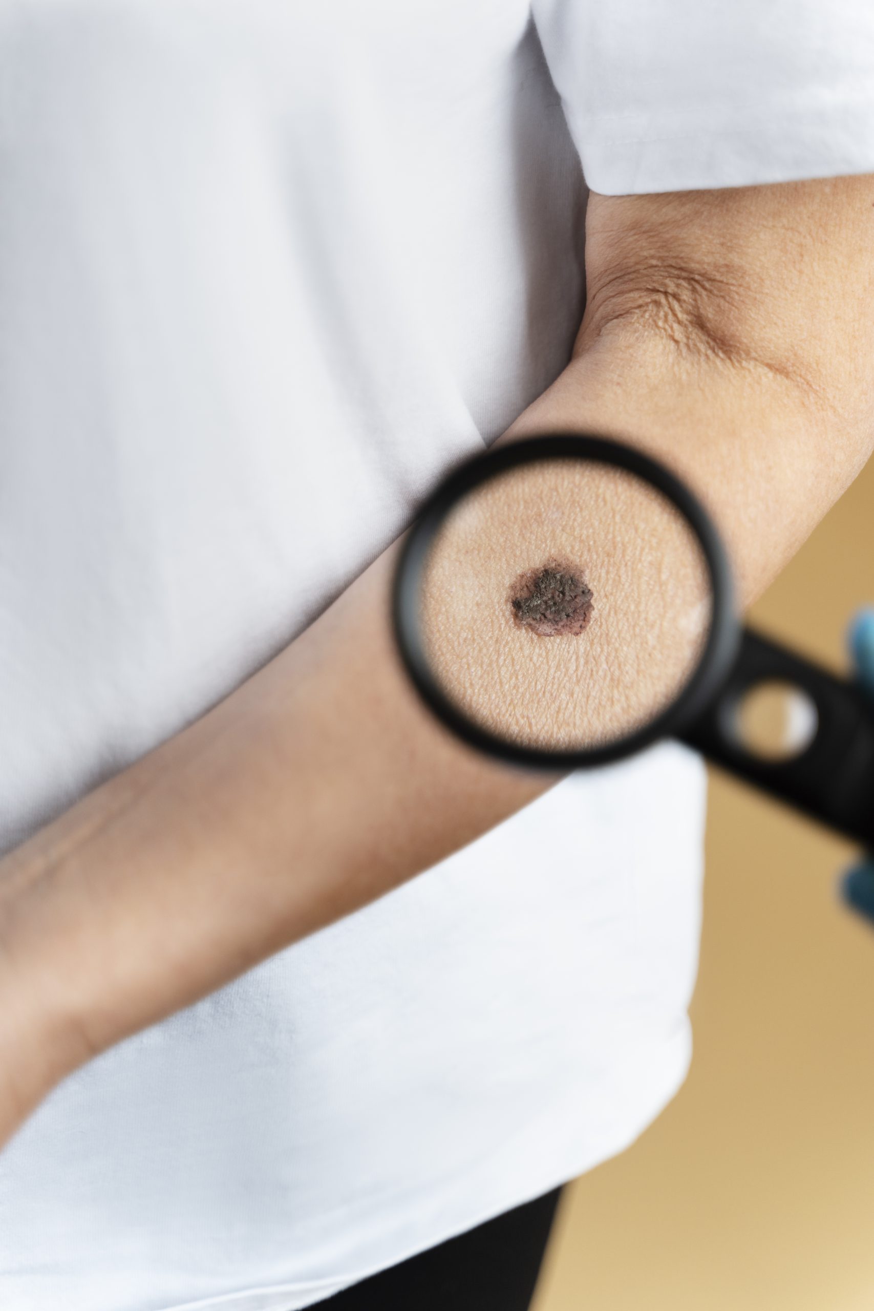 Dermoskopi ile ben takibi ve cilt kanseri risk değerlendirmesi – İzmir Alsancak Dr. Sedef Demirer