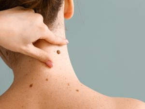 İzmir displastik ben ve dermatoskopik ben takibi Dr. Sedef Demirer