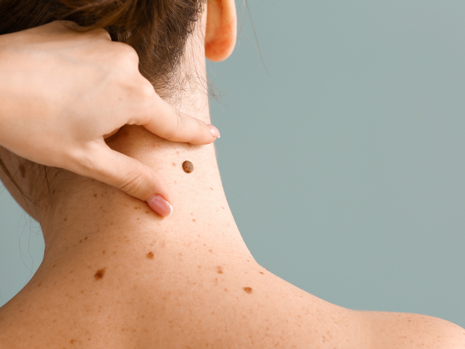 Displastik nevüs (atipik ben) dermatoskopik görünümü – İzmir Alsancak Dermatolog Dr. Sedef Demirer