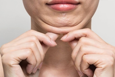 İzmir Alsancak’ta Dermatolog Dr. Sedef Demirer tarafından uygulanan Endolift ile ameliyatsız yüz ve boyun germe işlemi