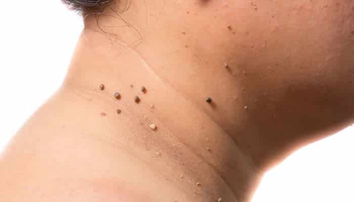 İzmir Alsancak’ta Dermatolog Dr. Sedef Demirer tarafından yapılan et beni aldırma işlemi