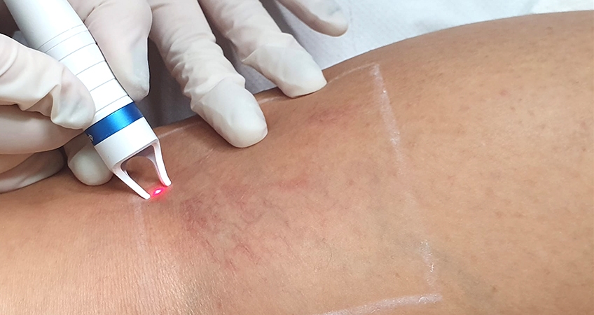 İzmir’de lazerle kılcal damar tedavisi uygulaması