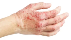 İzmir kontakt dermatit tanısı ve tedavisi Dr. Sedef Demirer