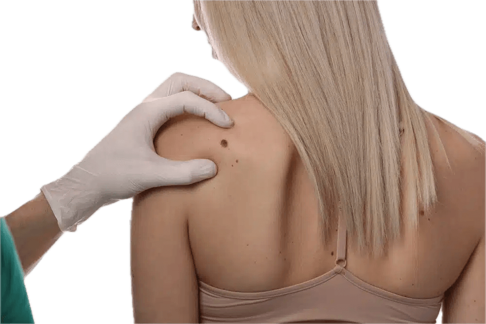 İzmir Alsancak’ta Dermatolog Dr. Sedef Demirer tarafından yapılan lazerle ben aldırma işlemi