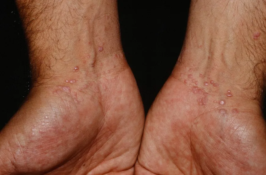 Liken planus deri hastalığı belirtileri ve dermatolojik muayene İzmir