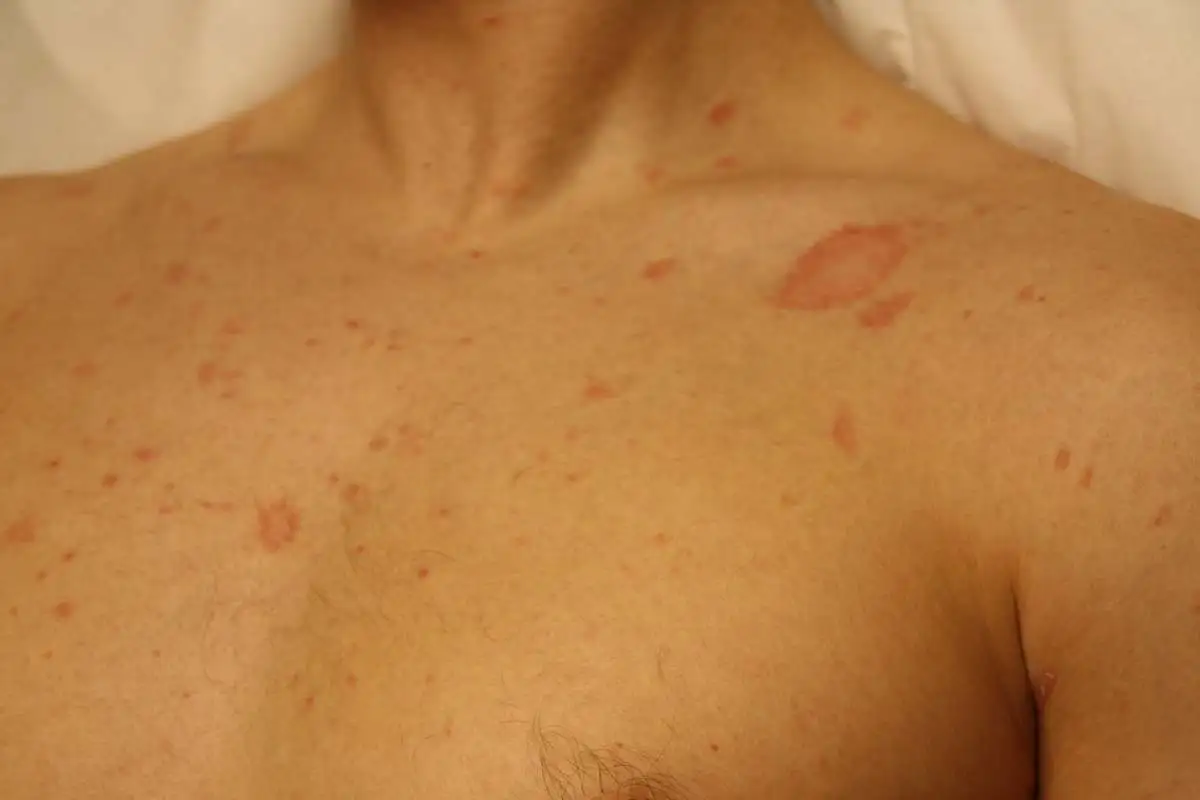 Pitiriyazis rozea gül hastalığı döküntüleri ve dermatolog muayenesi İzmir