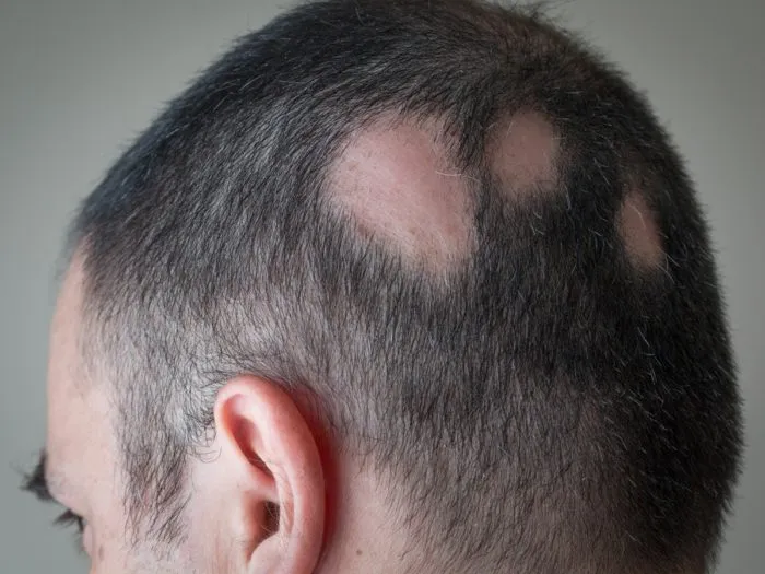 İzmir’de saçkıran (alopecia areata) tedavisi ve dermatolojik muayene