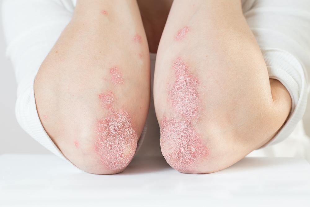 İzmir Alsancak’ta Dermatolog Dr. Sedef Demirer tarafından uygulanan sedef hastalığı (psoriasis) tedavisi
