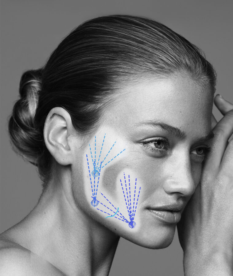 İzmir Alsancak’ta Dr. Sedef Demirer tarafından uygulanan sıvı yüz germe ile ameliyatsız yüz gençleştirme