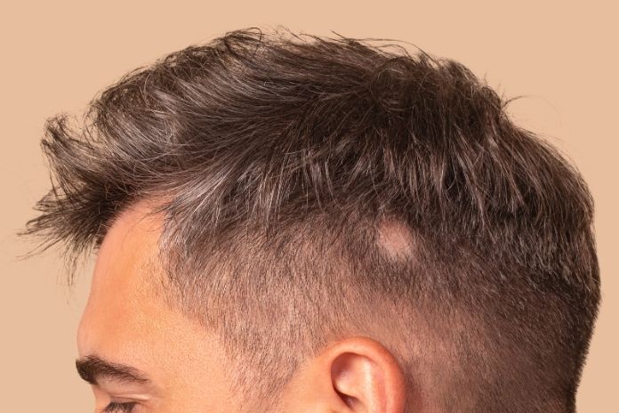 İzmir’de skatrisyel alopesiye bağlı kalıcı saç kaybının dermatolojik değerlendirmesi