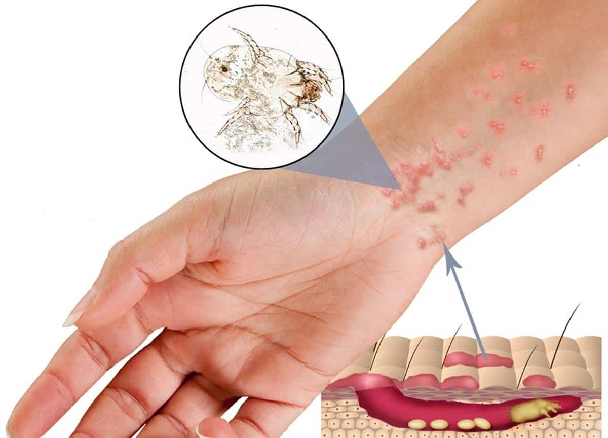 Uyuz hastalığının ciltte oluşturduğu belirtiler