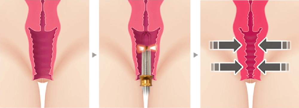 İzmir vajinal daraltma lazer tedavisi