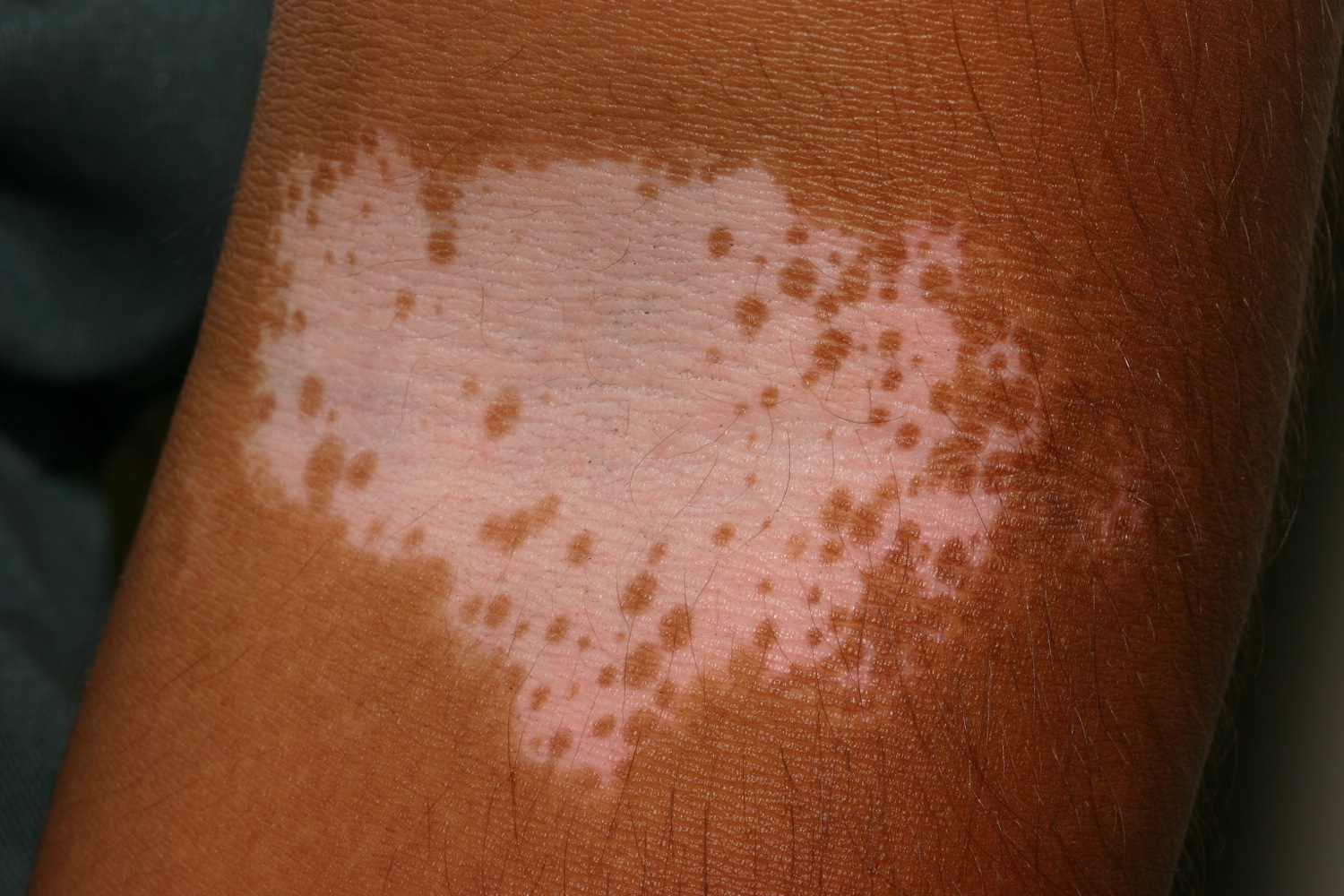 vitiligo nedir Vitiligo nedir beyaz cilt lekeleri