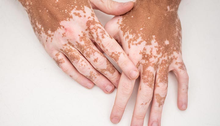 İzmir vitiligo tedavisi dermatolog
